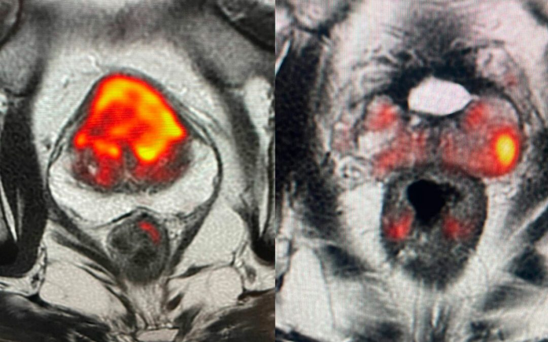 Cáncer de Próstata: diagnóstico