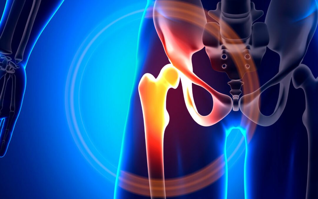 choque femoroacetabular