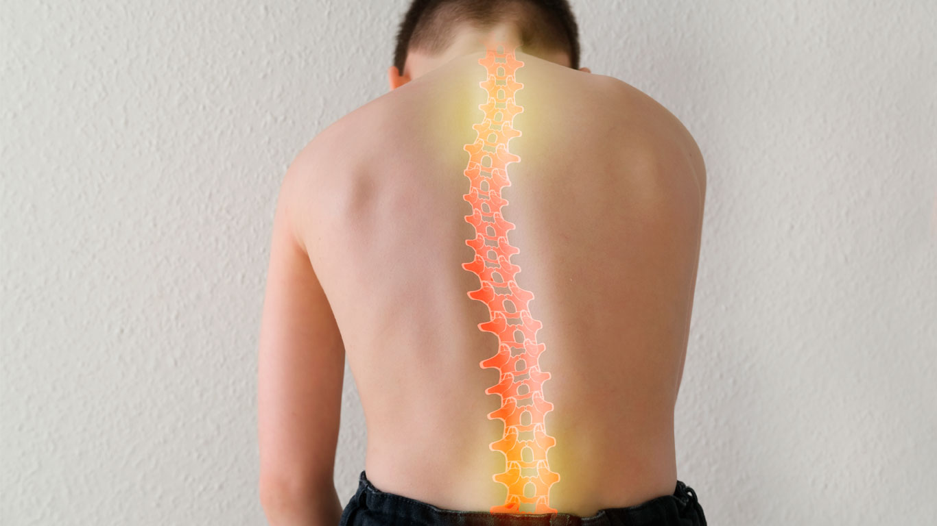 Escoliosis en niños: Detectar, Comprender y Abordar