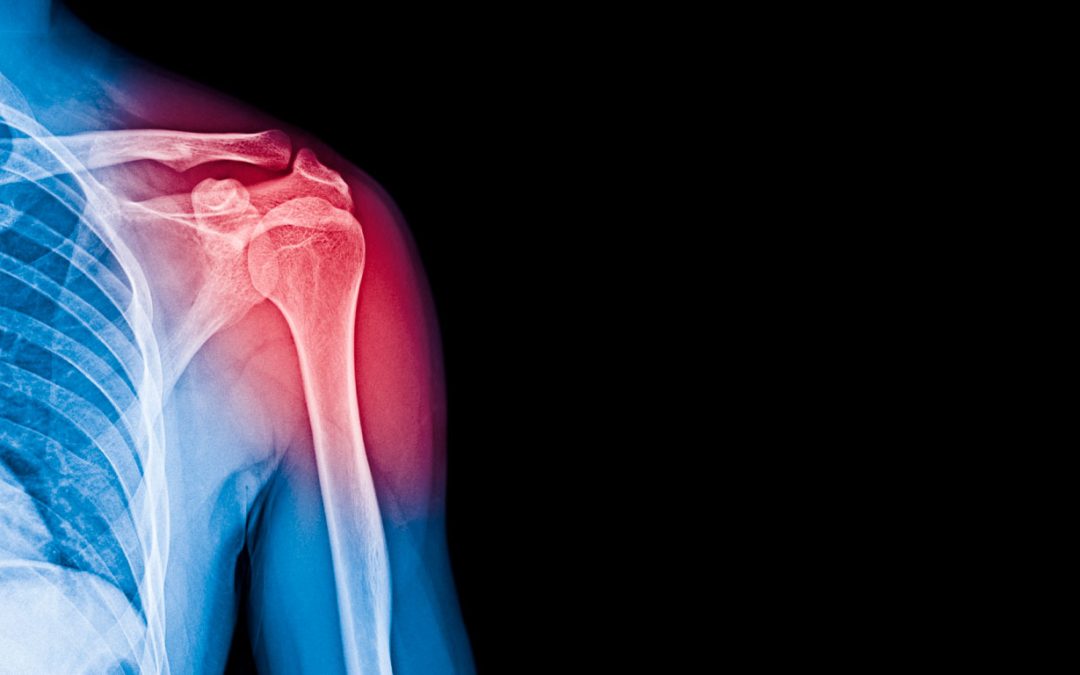 Tendinopatía Calcificante de Hombro. Decisiones Quirúrgicas