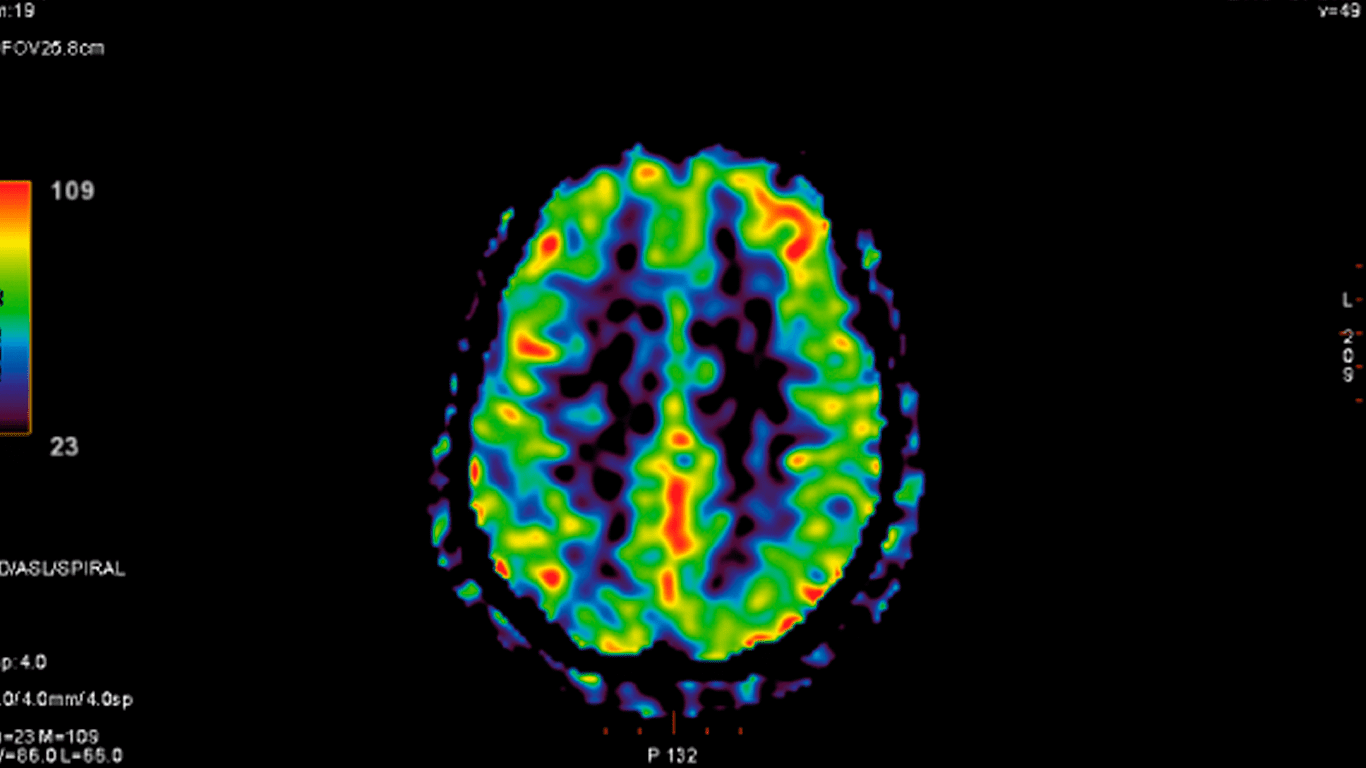 Perfusión cerebral mediante Resonancia Magnética una herramienta clave para el diagnóstico neurológico